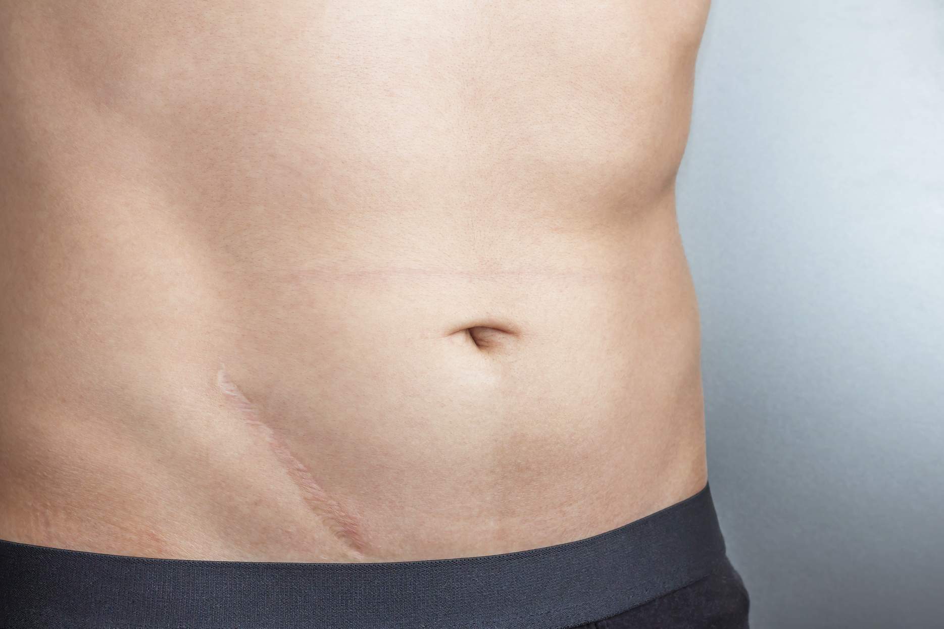 image of a male torso showing a small appendectomy scar. He is wearing black pants and the scar is showing just above them.