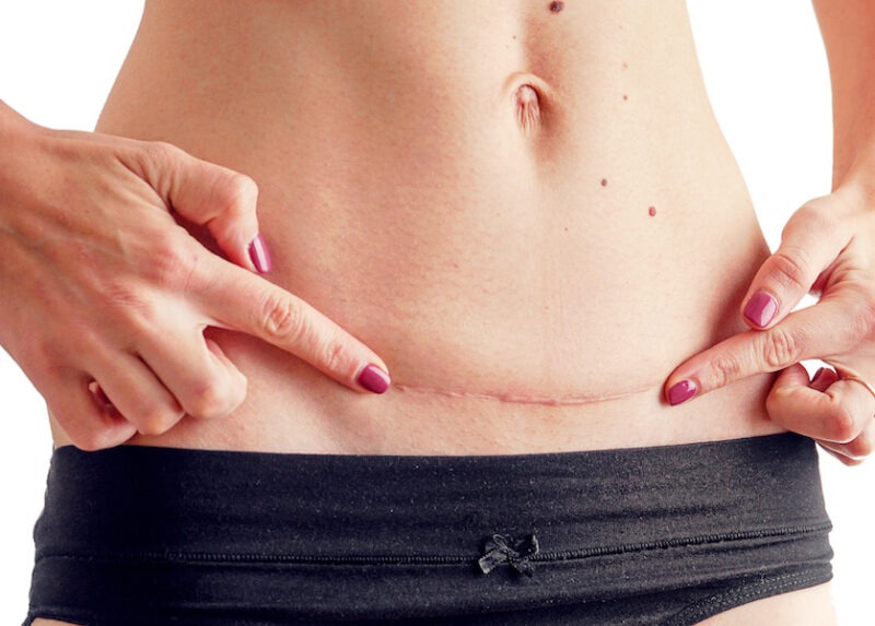 Photo of an abdominal scar from surgery to show what kind of scar ScarWork therapy can help with